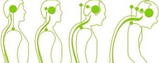 Cervical spine loses movement