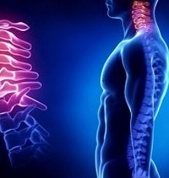 Cervical osteochondrosis can be caused by a neck injury